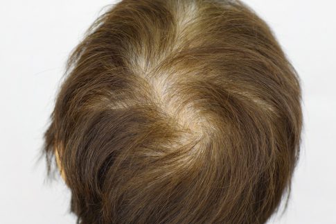 びまん性脱毛症とは 治療方法や特徴について