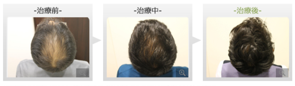 40代男性 AGA内服薬+ノーニードル育毛メソセラピー治療 治療前と治療後