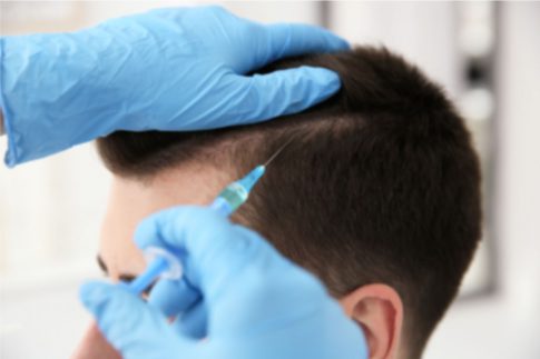 毛髪再生医療の「HARG療法」の効果・施術方法・副作用について