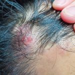 脂漏性皮膚炎とは　その原因と治療法について