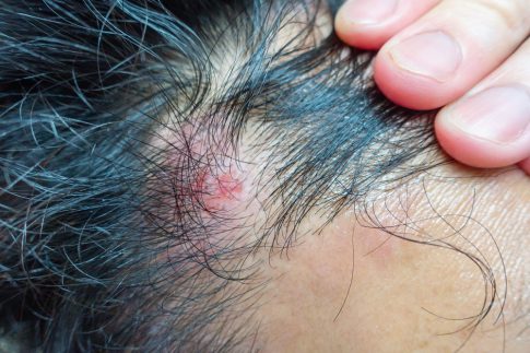 脂漏性皮膚炎とは　その原因と治療法について
