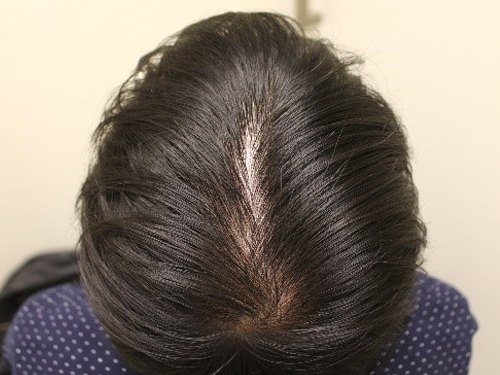 症例写真case16_頭頂部を中心に軽度の毛髪密度の低下