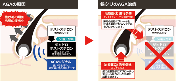AGAの原因の図解