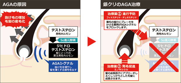 AGAのしくみ、銀クリの治療法