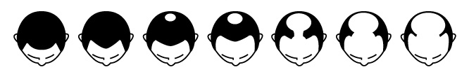 AGA（男性型脱毛症）の典型的なM字やO字の薄毛症状の図説