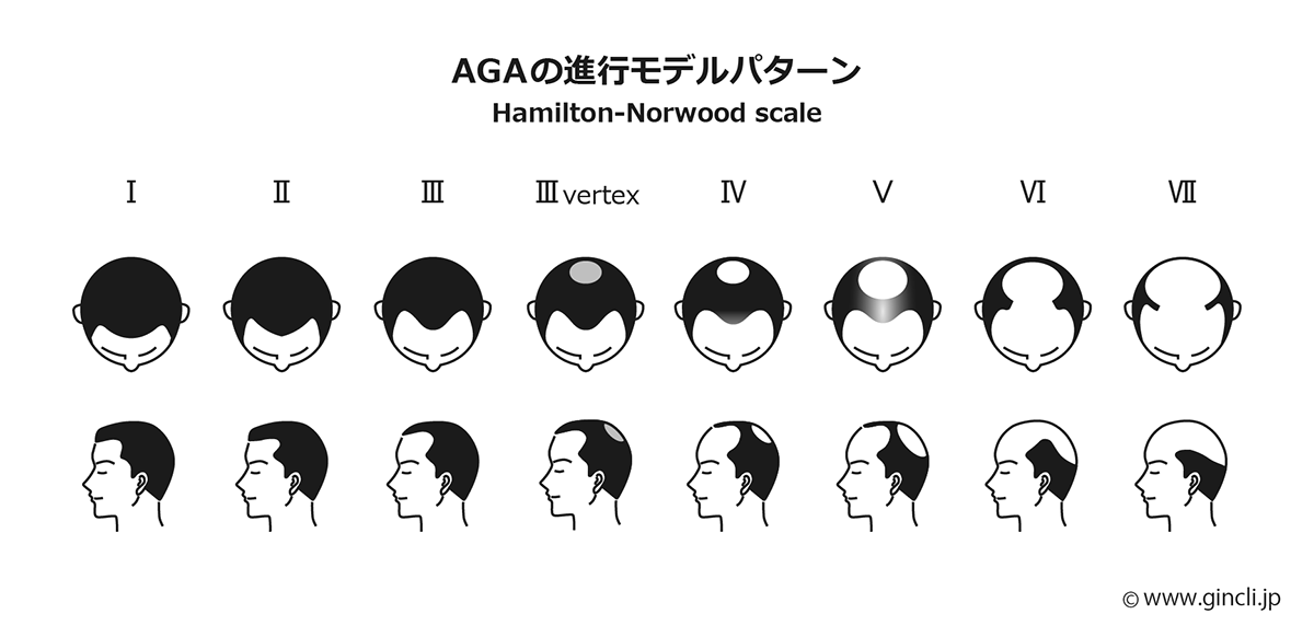 AGA（男性型脱毛症）の仕組み 毛周期（ヘアサイクル）の図説