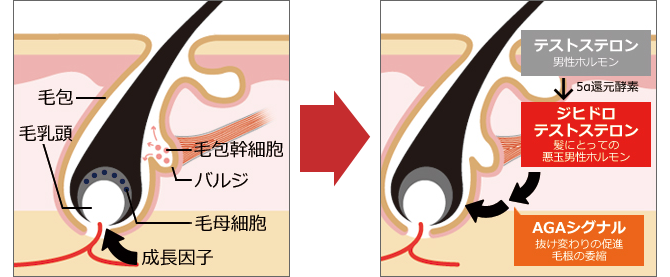 AGAの原因とはの図説