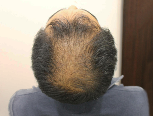 40代男性 生やすAGA治療 治療前