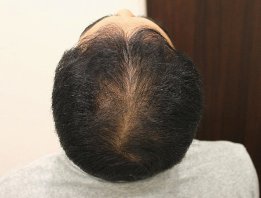 40代男性 生やすAGA治療 治療中