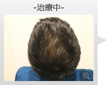 40代男性 AGA内服薬+ノーニードル育毛メソセラピー治療 治療中（症例写真）