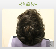 40代男性 AGA内服薬+ノーニードル育毛メソセラピー治療 治療後（症例写真）