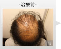 40代男性 AGA内服薬+ノーニードル育毛メソセラピー治療 治療前（症例写真）