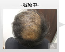 40代男性 AGA内服薬+ノーニードル育毛メソセラピー治療 治療前中（症例写真）