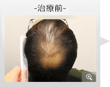 20代男性 AGA内服薬治療 治療前（症例写真）