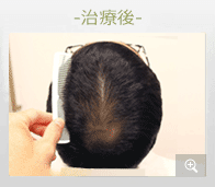 20代男性 AGA内服薬治療 治療後（症例写真）