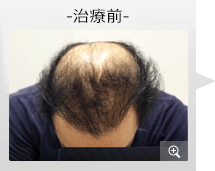 40代男性 AGA内服薬治療 治療前（症例写真）