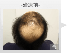 40代男性 AGA内服薬治療 治療前（症例写真）