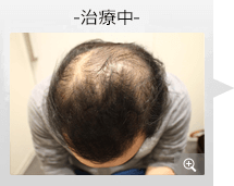 40代男性 AGA内服薬治療 治療中（症例写真）