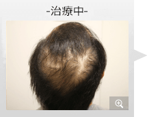 40代男性 AGA内服薬治療 治療中（症例写真）