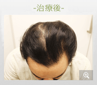 40代男性 AGA内服薬治療 治療後（症例写真）