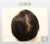 40代男性 AGA内服薬治療 治療後（症例写真）