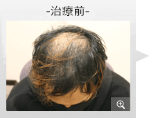 20代男性 AGA内服薬治療 治療前（症例写真）