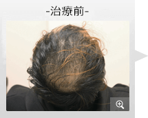 20代男性 AGA内服薬治療 治療前（症例写真）