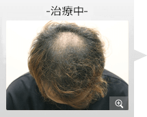 20代男性 AGA内服薬治療 治療中（症例写真）