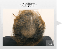 20代男性 AGA内服薬治療 治療中（症例写真）