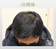 20代男性 AGA内服薬治療 治療後（症例写真）