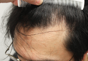30代男性 AGA内服薬+銀クリLEDセラピー治療 治療前（前頭部症例写真）