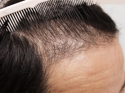 40代男性 AGA内服薬+植物性幹細胞ブースターメソセラピー治療 治療前(前頭部症例写真)