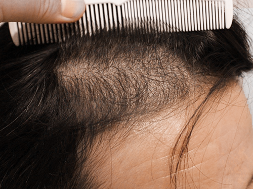 40代男性 AGA内服薬+植物性幹細胞ブースターメソセラピー治療 治療開始から3ヶ月後(前頭部症例写真)