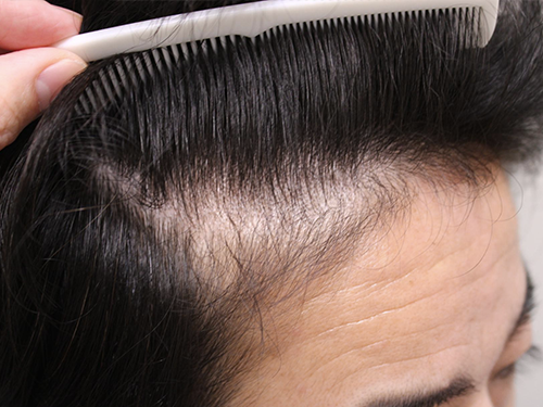 40代男性 AGA内服薬+植物性幹細胞ブースターメソセラピー治療 治療開始から9ヶ月後(前頭部症例写真)