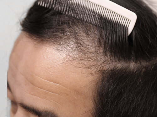 40代男性 AGA内服薬+植物性幹細胞ブースターメソセラピー治療 治療前(前頭部症例写真)