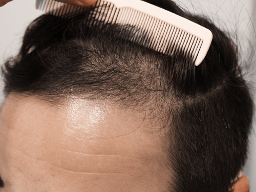 40代男性 AGA内服薬+植物性幹細胞ブースターメソセラピー治療 治療開始から3ヶ月後(前頭部症例写真)