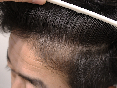 40代男性 AGA内服薬+植物性幹細胞ブースターメソセラピー治療 治療開始から9ヶ月後(前頭部症例写真)