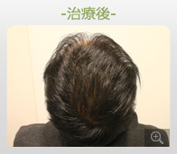 30代男性 AGA内服薬+ノーニードル育毛メソセラピー治療 治療後（症例写真）