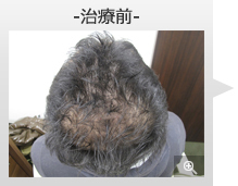 30代男性 AGA内服薬治療 治療前（症例写真）