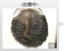 30代男性 AGA内服薬+ノーニードル育毛メソセラピー治療 治療中（症例写真）
