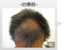 30代男性 AGA内服薬+ノーニードル育毛メソセラピー治療 治療前（前頭部症例写真）