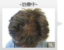 30代男性 AGA内服薬+ノーニードル育毛メソセラピー治療 治療中（前頭部症例写真）