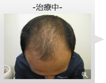 30代男性 AGA内服薬+ノーニードル育毛メソセラピー治療 治療中（症例写真）