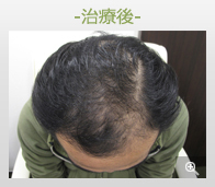 30代男性 AGA内服薬+ノーニードル育毛メソセラピー治療 治療後（症例写真）