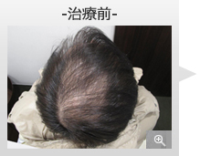30代男性 AGA内服薬+グロースファクター育毛メソセラピー治療 治療前（症例写真）