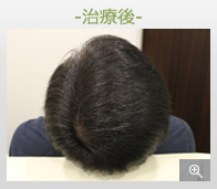30代男性 AGA内服薬+グロースファクター育毛メソセラピー治療 治療後（症例写真）