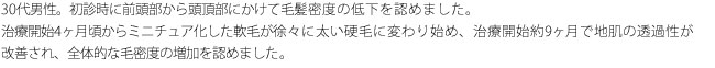 40代男性。初診時に前頭部を中心に広範な毛髪密度の低下を認めました。成長の可能性のある軟毛を多数認めたため、まず内服治療を選択しました。治療開始から半年で明確な毛量変化を認め、約1年で頭頂部の症状は改善しました。