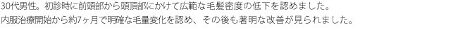 40代男性。初診時に前頭部を中心に広範な毛髪密度の低下を認めました。成長の可能性のある軟毛を多数認めたため、まず内服治療を選択しました。治療開始から半年で明確な毛量変化を認め、約1年で頭頂部の症状は改善しました。