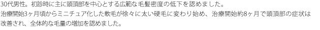 40代男性。初診時に前頭部を中心に広範な毛髪密度の低下を認めました。成長の可能性のある軟毛を多数認めたため、まず内服治療を選択しました。治療開始から半年で明確な毛量変化を認め、約1年で頭頂部の症状は改善しました。