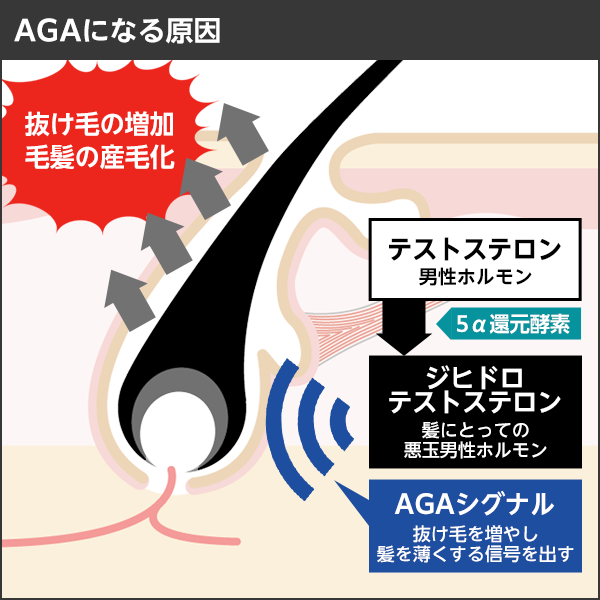 AGAになる原因の図説　血中のテストステロン（男性ホルモン）が5α還元酵素と結合しジヒドロテストステロン（悪玉男性ホルモン）に変化し、AGAシグナル（抜け毛を増やし髪を薄くする信号）を出すことでヘアサイクルを乱し抜け毛や薄毛の症状が出ます。